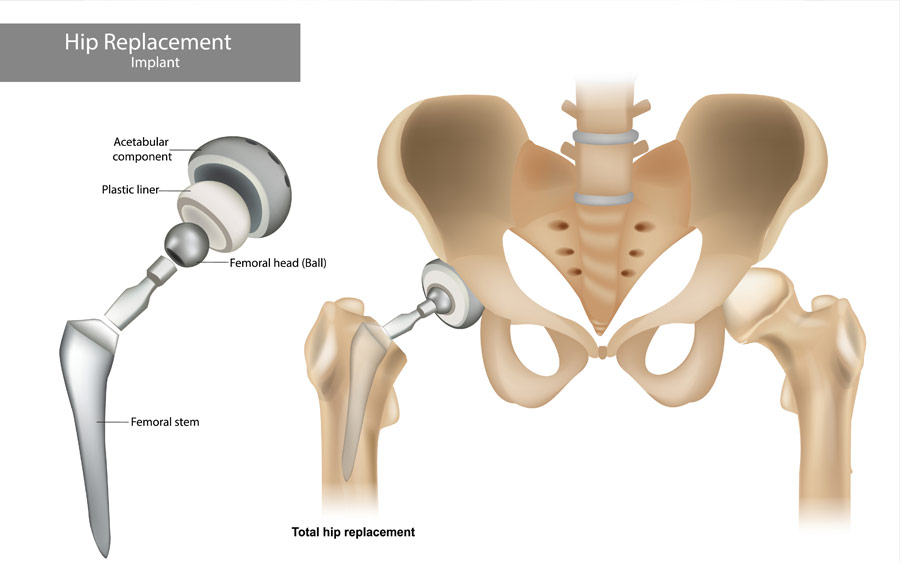 οστεοαρθρίτιδα του ισχίου