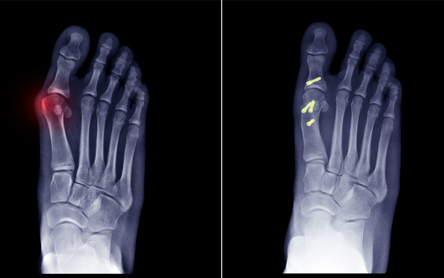 Βλαισός μέγας δάκτυλος